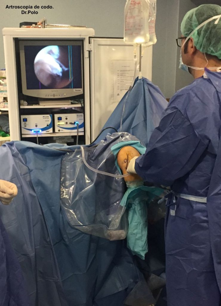 Figura 1 - Artroscopia de codo