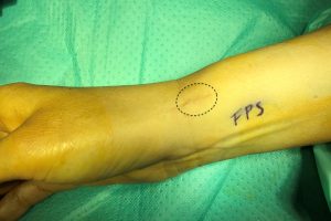 PATOLOGIAS MUÑECA - TENDINITIS de DE QUERVAIN Figura 2 - Cicatriz post-quirúrgica tras cirugía de tendinitis de De Quervain