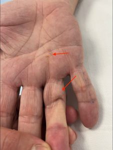 PATOLOGIAS MUÑECA - TUMORES DE LA MANO Y LA MUÑECA Figura 3 - Enfermedad de Dupuytren que afecta a mano y dedo