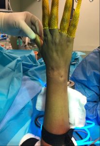 GANGLIONES Figura 4 - Resultado postquirúrgico inmediato y abordaje mínimamente invasivo