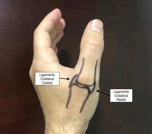 PATOLOGÍAS EN MANO Y DEDOS - PULGAR DEL ESQUIADOR:LIGAMENTO COLATERAL CUBITAL