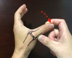 PATOLOGÍAS EN MANO Y DEDOS - PULGAR DEL ESQUIADOR:LIGAMENTO COLATERAL CUBITAL Figura 2 - Mecanismo de lesión del pulgar del esquiador