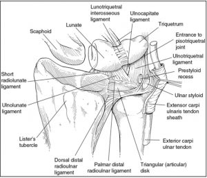 PATOLOGIAS MUÑECA - LESIÓN DEL LIGAMENTO ESCAFOLUNAR DE LA MUÑECA Figura 2 - RMN muestra lesión de Ligamento E-L