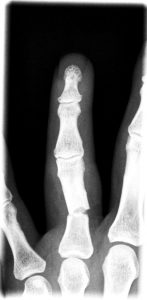 PATOLOGÍAS EN MANO Y DEDOS - FRACTURAS DE LA MANO Figura 1 - Fractura falange proximal 4º dedo