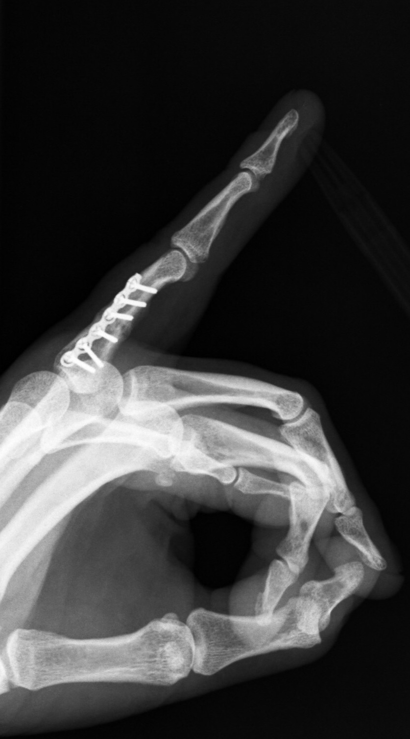 FRACTURAS DE LA MANO Figura 5 - Osteosíntesis con placa fractura falange proximal 4º dedo