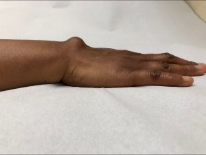 PATOLOGIAS MUÑECA - GANGLIONES Figura 1 - Ganglión en dorso de muñeca