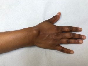 PATOLOGIAS MUÑECA - GANGLIONES Figura 2 - Ganglión en dorso de muñeca