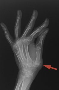 PATOLOGÍAS EN MANO Y DEDOS - RIZARTROSIS Figura 1 - Radiografía de una Rizartrosis