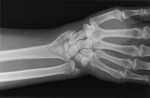 PATOLOGIAS MUÑECA - FRACTURAS DE LA MUÑECA Figura 1 - Fractura de muñeca o fractura de extremidad distal del radio.