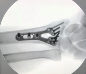 PATOLOGIAS MUÑECA - FRACTURAS DE LA MUÑECA Figura 2 - Fijación de fractura de muñeca con placa y tornillos.
