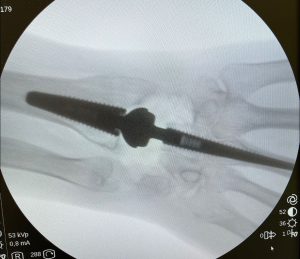 PATOLOGIAS MUÑECA - PRÓTESIS ARTICULARES Figura 1 - Prótesis radio-carpiana de 4ª generación