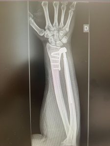 PATOLOGIAS MUÑECA - PRÓTESIS ARTICULARES Figura 3 - Radiografía de Prótesis total de Articulación Radio-Cubital distal