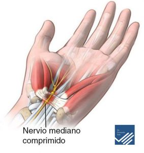 PATOLOGIAS MUÑECA - SÍNDROME DEL TUNEL CARPIANO Figura 1 - Compresión del Nervio Mediano en el túnel carpiano