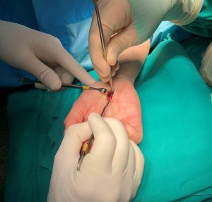 PATOLOGIAS MUÑECA - SÍNDROME DEL TUNEL CARPIANO Figura 3 - Cirugía del Síndrome del Túnel Carpiano