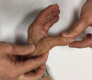 PATOLOGÍAS EN MANO Y DEDOS - PULGAR DEL ESQUIADOR:LIGAMENTO COLATERAL CUBITAL Figura 3 - Inestabilidad del pulgar tras una rotura completa de Ligamento Colateral Cubital