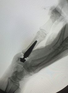 RIZARTROSIS Figura 3 - Prótesis de articulación TMC por rizartrosis AP