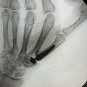 RIZARTROSIS Figura 4 - Prótesis de articulación TMC por rizartrosis LAT